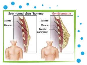 gynécomastie homme tunisie