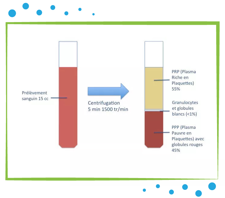 INJECTION-DE-PRP