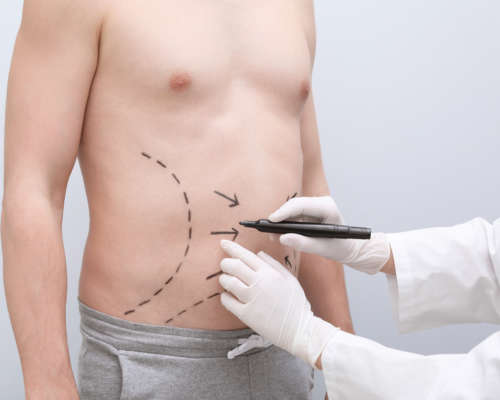 liposuccion tunisie homme liposuccion tunisie homme