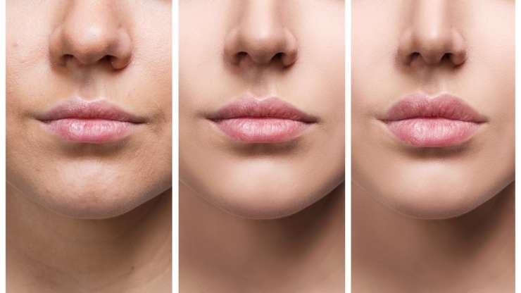 Le liplift c’est quoi?