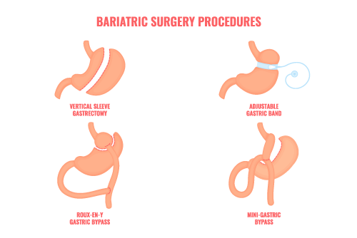 Opération pour maigrir, chirurgie bariatrique tunisie