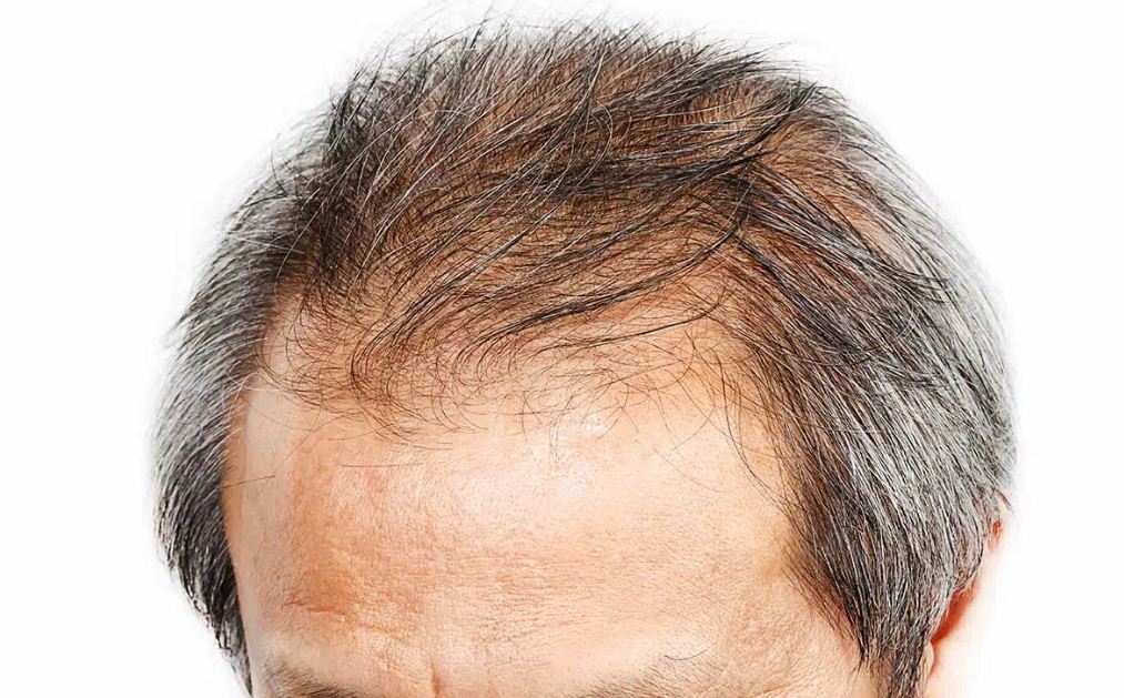 Greffe de cheveux avant apres star : Le secret d’une chevelure digne d’une star