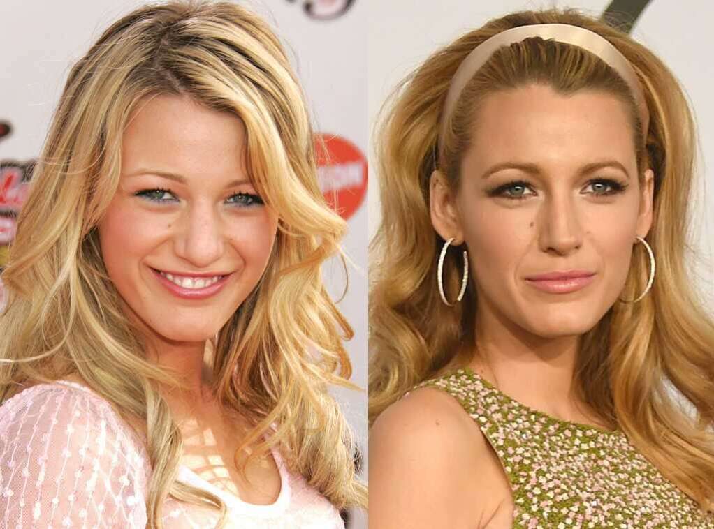 Blake Lively chirurgie dentaire comment son sourire l'a changé