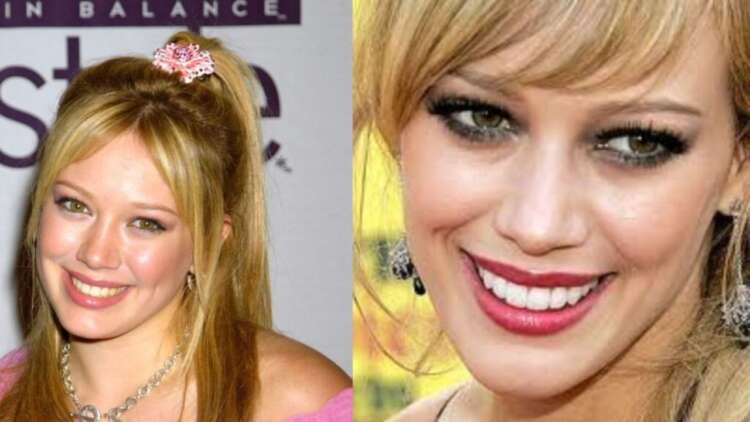 hilary duff chirurgie dentaire