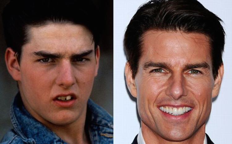 tom cruise chirurgie dentaire