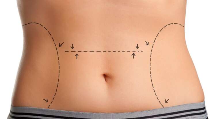 Transformez votre corps grâce à la chirurgie de l’abdomen : le Tummy Tuck en Tunisie