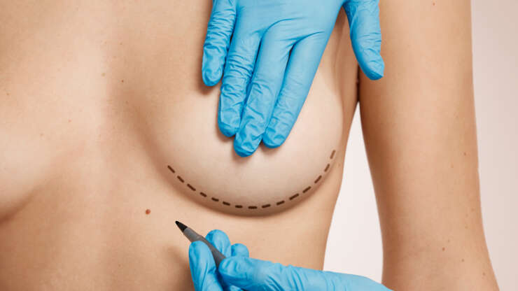 actualité de la chirurgie esthetique: augmentation mammaire