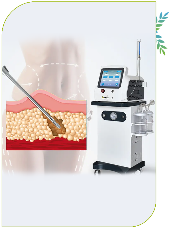 liposuccion laser prix