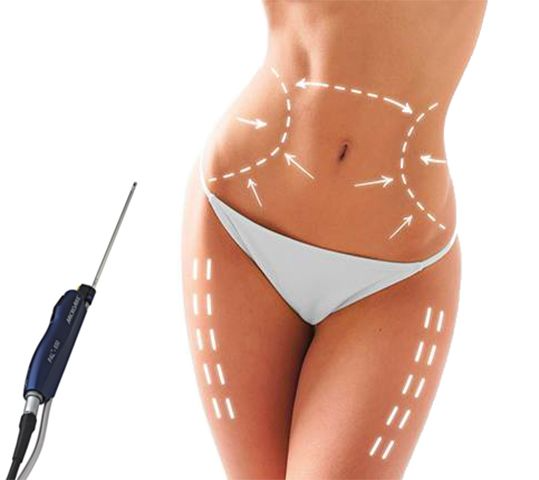 liposuccion assistée par vibration PAL