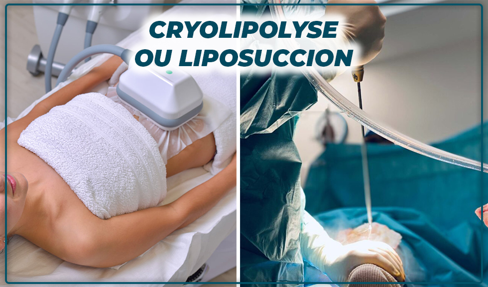 Cryolipolyse ou liposuccion