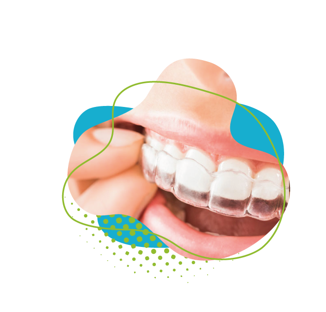 Invisalign : confort et discrétion pour un alignement dentaire idéal !