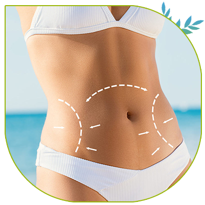 Abdominoplastie avec transposition du nombril