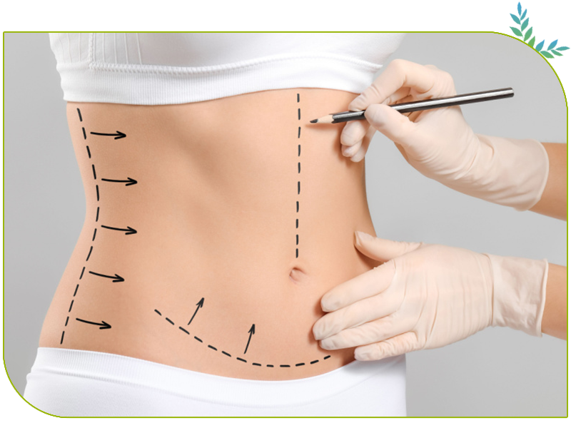 abdominoplastie haute tension