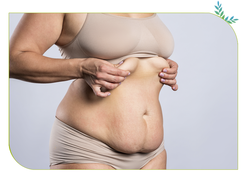 abdominoplastie 10 ans après 