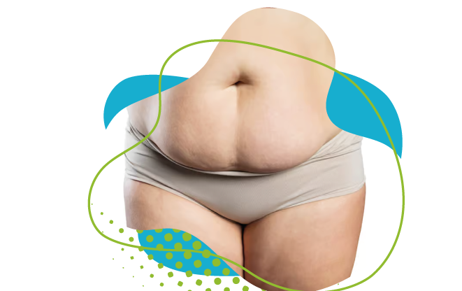Abdominoplastie 10 ans après : Résultats et évolution à long terme