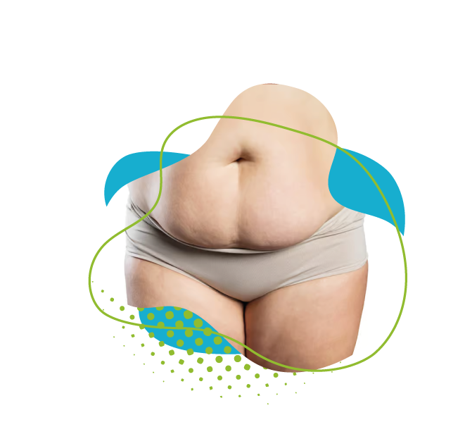 Abdominoplastie 10 ans après : Résultats et évolution à long terme