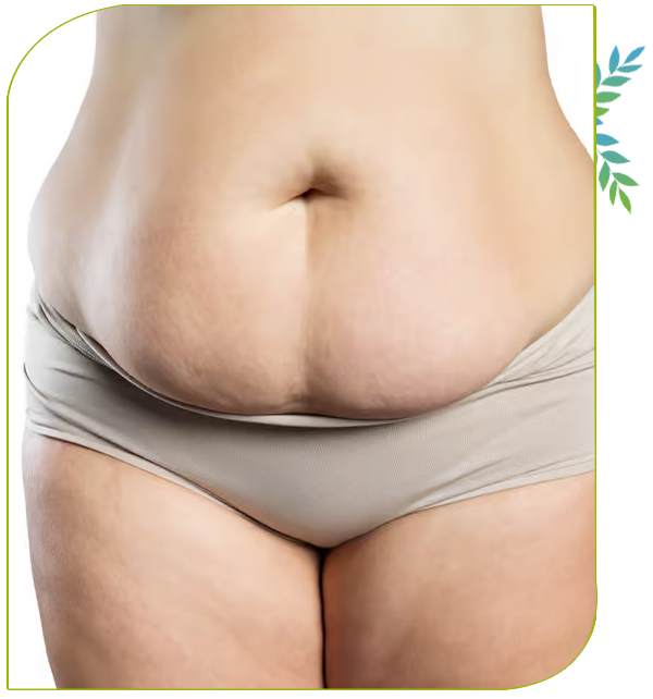 abdominoplastie 