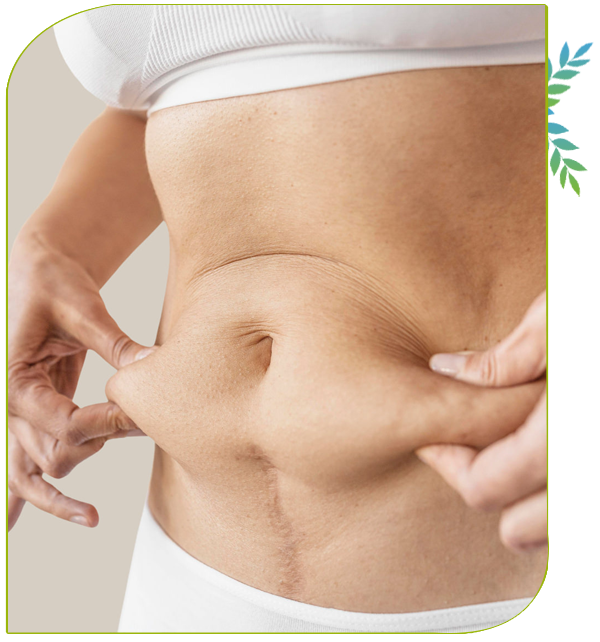 types d'abdominoplastie 