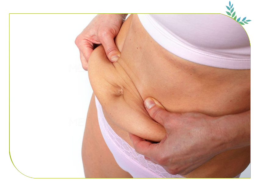 Différents types d'abdominoplastie en Tunisie