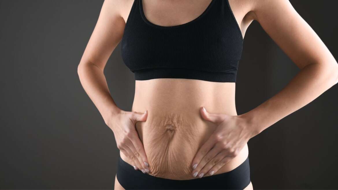 Comment Remédier à un Ventre Relâché: Solutions Chirurgicales et Non-Chirurgicales
