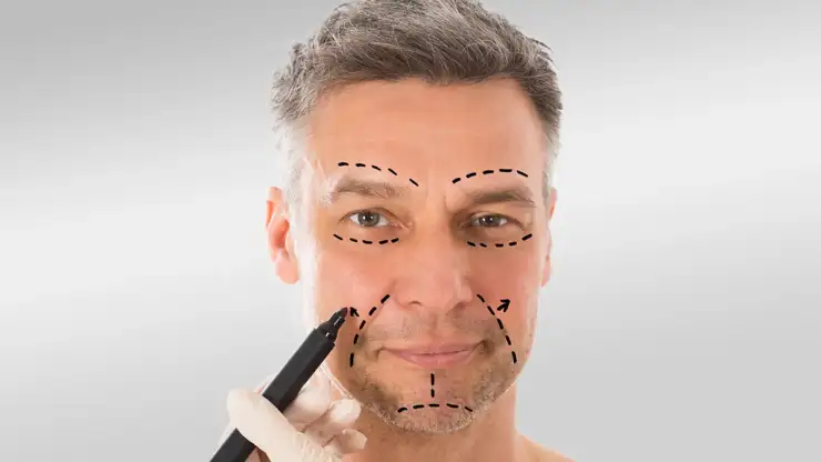 Liposuccion visage homme :  Une Solution Efficace pour Redessiner les Contours Masculins