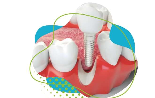 Type de couronne dentaire : Lequel choisir ?