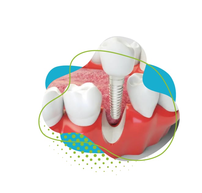 Type de couronne dentaire : Lequel choisir ?
