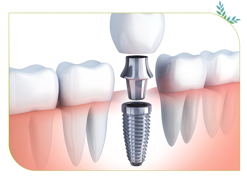 type de couronne dentaire en Tunisie