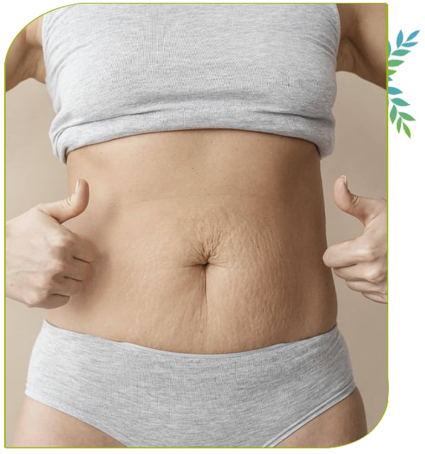 Abdominoplastie secondaire et tourisme médical en Tunisie 